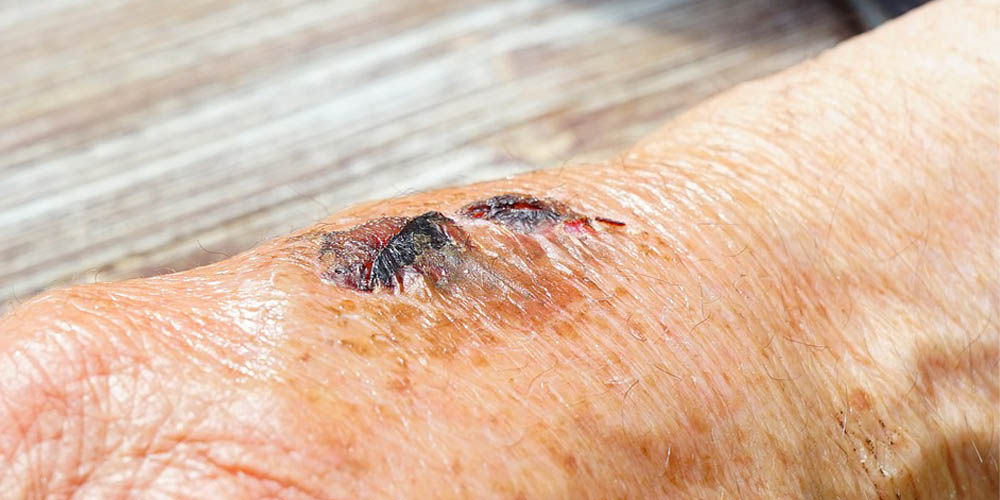 90-årig med dybt tryksår