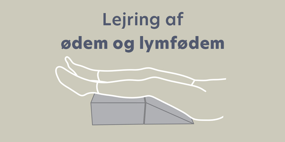 Lejring af ødem og lymfødem – 5 eksempler
